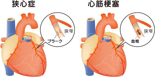 梗塞 背中 心筋