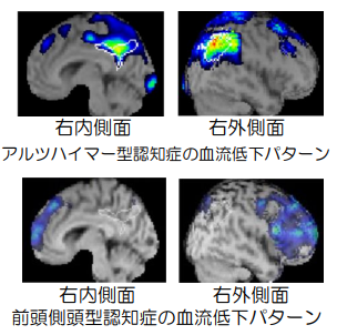脳血流統計解析画像