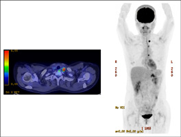 PET-CT画像