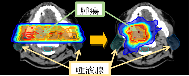 強度変調放射線治療