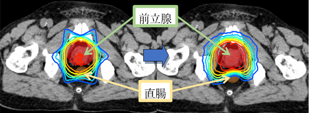 強度変調放射線治療