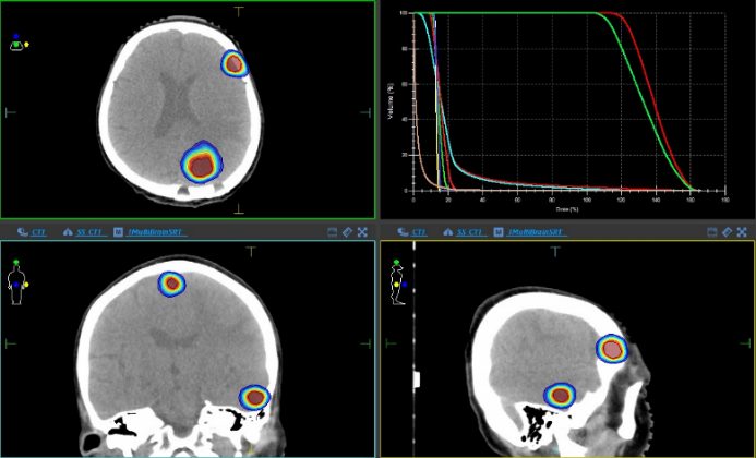 多発脳転移に対する脳定位