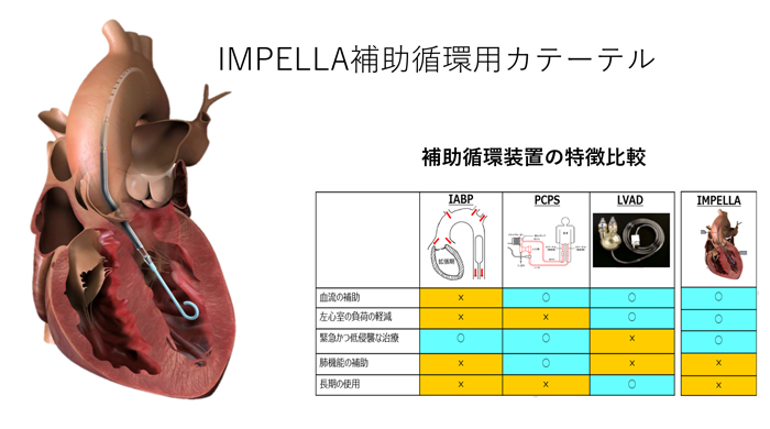 補助循環用カテーテル